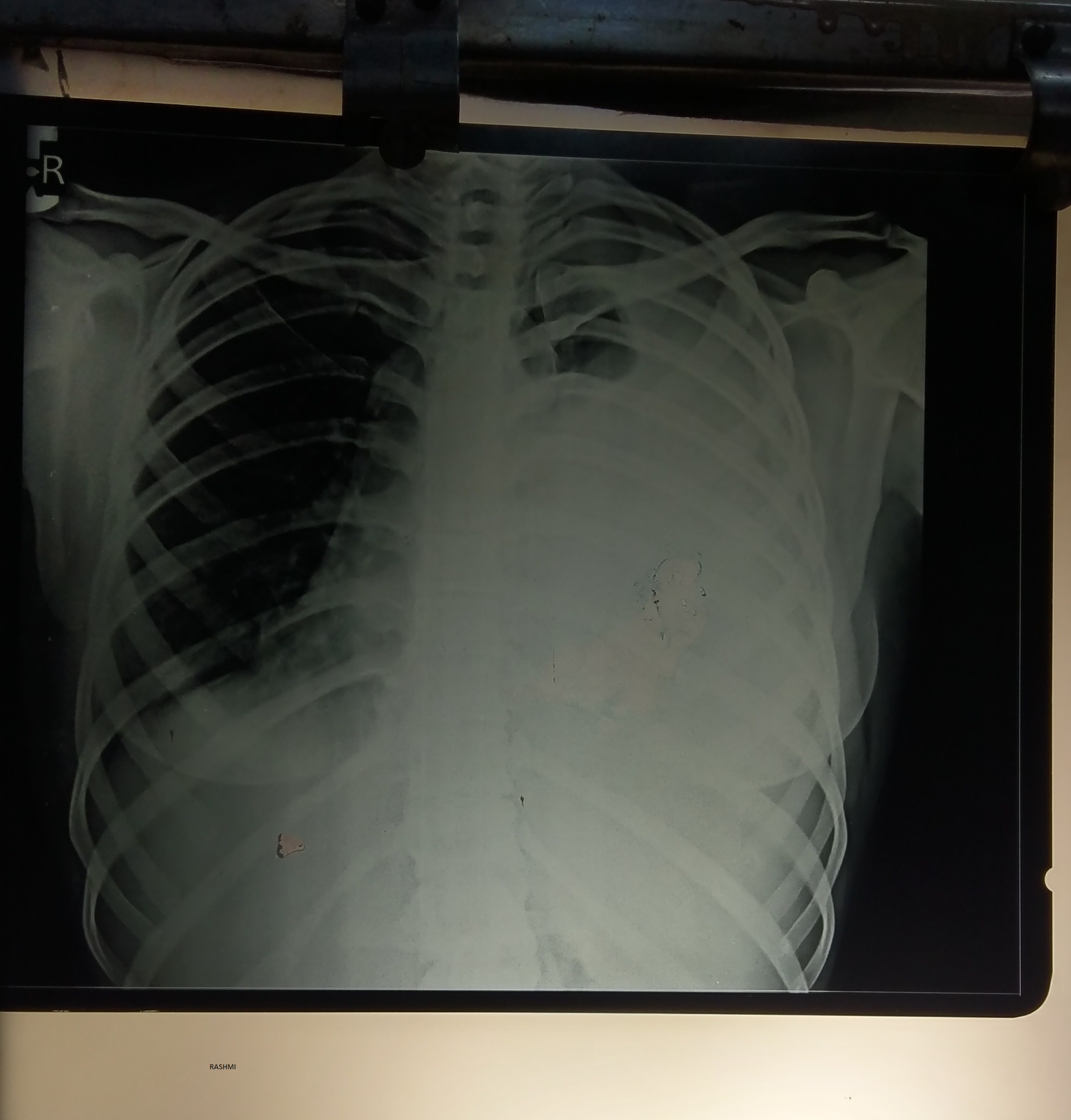 Left Side Massive Pleural Effusion